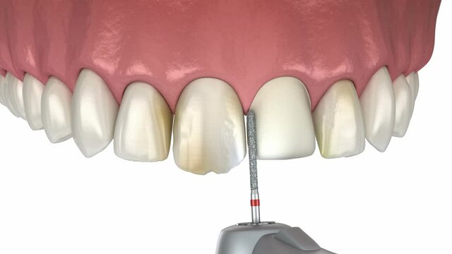 Veneers - preparation, mockup, color choosing and placement of dental veneers over central incisor and lateral incisor. Medically accurate tooth 3D animation