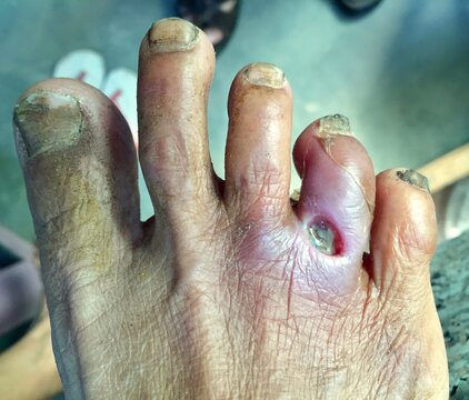 Diabetes foot ulcer in foot of Asian patient.