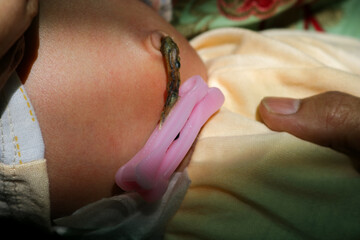 Umbilical cord of newborn baby attached to the belly button