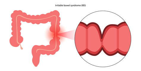 Irritable bowel syndrome