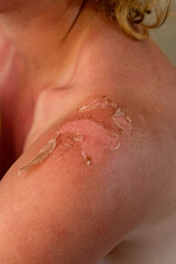 Fototapeta premium Severe sunburn of the shoulders. Burns from prolonged negative effects on the skin of sunlight. The consequences of prolonged exposure to the sun