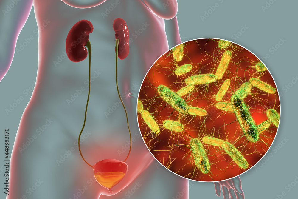 Wall mural Cystitis, bacterial infection of urinary bladder, conceptual 3D illustration