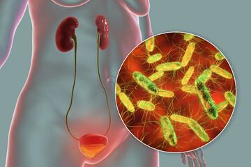 Cystitis, bacterial infection of urinary bladder, conceptual 3D illustration - obrazy, fototapety, plakaty