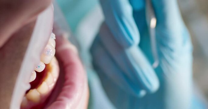 Close-up male open mouth with optragate and on the upper jaw is ceramic braces, the orthodontist is removing unnecessary glue from the brace.
