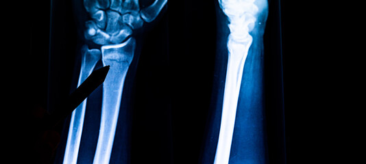 Radiography examination of radius fracture. X-ray human arm. X-ray of hand bones. Medical technology radiography. X-ray film.