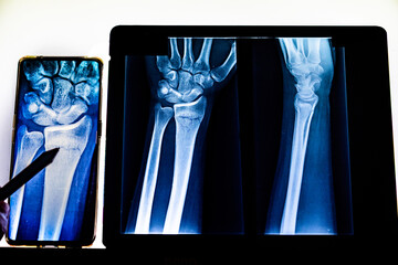 Radiography examination of radius fracture. X-ray human arm. X-ray of hand bones. Medical technology radiography. X-ray film.