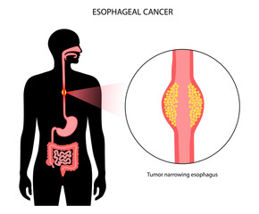 esophageal cancer concept