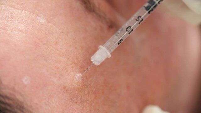 Botox injection by a beautician with a syringe into a man's forehead. Close up.