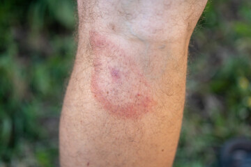 migrating erythema after a tick bite on a man's leg. a symptom of tick-borne borreliosis. a red...