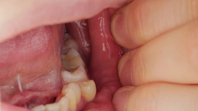 Deep caries in the patient's jaw tooth and displacement of the crooked tooth. Dental treatment concept in dentistry, macro