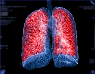 Selective focus of CT Chest or Lung 3D rendering image on the monitor  for diagnosis TB,tuberculosis and covid-19 .