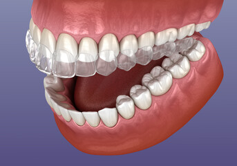 Invisalign braces or invisible retainer. Medically accurate dental 3D illustration