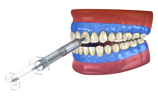 Professional teeth whitening. Adding gel over teeth. 3D illustration concept.