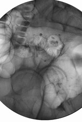 Barium enema image or x-ray image of large intestine. Colorectal x-ray