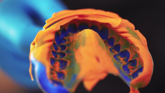 Dentist in medical gloves shows the impression of the teeth for the installation of veneers. Dental clinic and medicine concept. Close-up. Unrecognizable person.