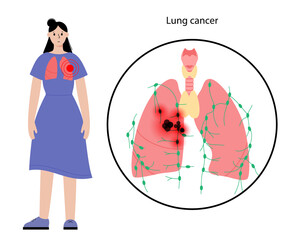 Lungs cancer disease