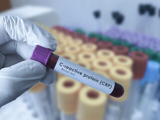 CRP blood test
