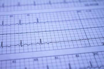 Close-up of an EKG with arrhythmia problems. Heartbeat recorded on paper.