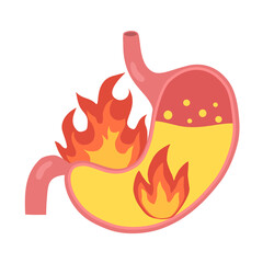 Human stomach on fire in flat design on white background. Heartburn concept. Acid reflux disease.