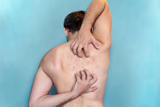 A man scratches the skin on his back. Itching on the back. Man scratching his back on bluy background