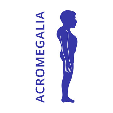 Acromegalia, acromegaly. Neuroendocrine disease. Pituitary gland disease. Silhouette of man, boy isolated on white backgound. Vector illustration. EPS10.