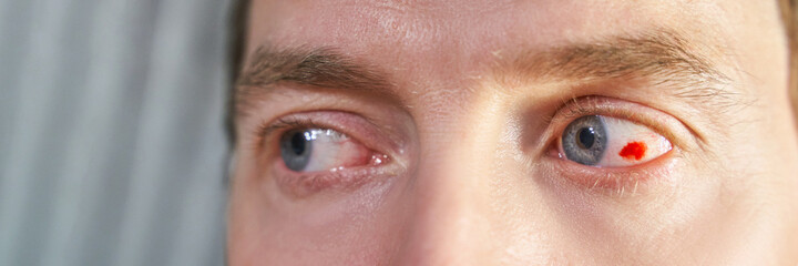 Obraz premium Man damaged eye ball. Conjunctivitis blood. Allergy ophtalmology test. Medical redness concept. Astigmatism problem. Closeup