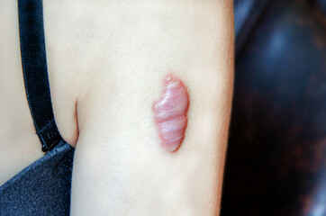 close-up of keloid scar on the shoulder of young woman. Rough scar. tumor-like growth of coarse...