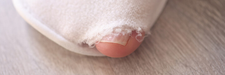 Big toe of man foot is sticking out of torn sneaker