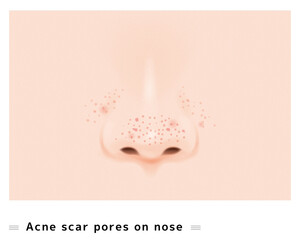 鼻 鼻の穴 毛穴 ニキビ ケア 美容 治療 スキンケア 穴 ポツポツ 目立つ ボコボコ 赤い イラスト ベクター
