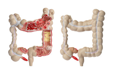 Anatomical model of large intestine on white background, collage. Gastroenterology