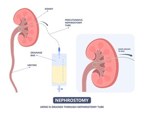 Tube Stent bag blocked kidney stone tumor urine urinary Drain renal ileal conduit stoma foley bladder pelvis Obstructive ureter shock wave ESWL pain cystitis remove surgery pee Cancer tract transplant