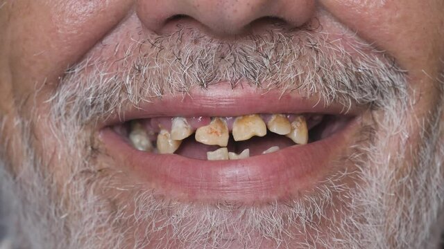 close-up shot of a toothless male mouth.A man with bad teeth. Man showing his rotten teeth, caries, decayed and weak enamel, teeth falling out, dental problems