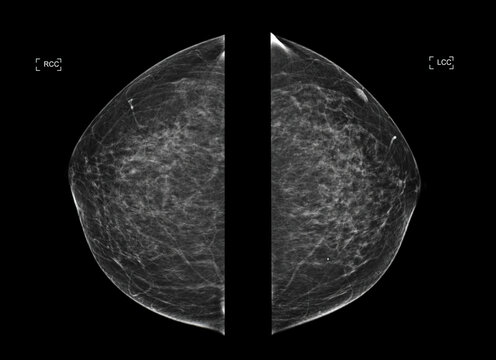  X-ray Digital Mammogram  or mammography  both side of the breast  CC view  for diagnonsis Breast cancer in women
