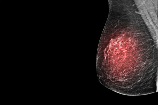  X-ray Digital Mammogram  or mammography  both side of the breast  MLO view  for diagnonsis Breast cancer in women isolated on black background.