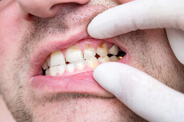 Bad teeth of a middle-aged man. Chipped and cracked tooth enamel, enamel hypoplasia, malocclusion...