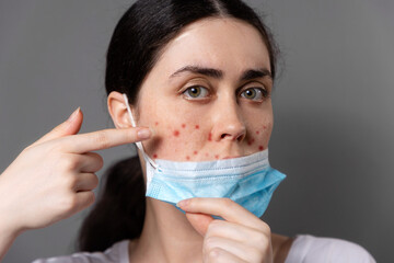 Maskne. Portrait of a young Caucasian woman shows pimples on her cheeks from wearing a protective mask. Gray background. The concept of acne and skin irritation