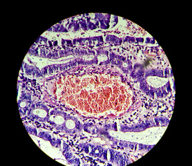 Microscopic image of a villous adenoma. Adenomas are premalignant (precancerous) polyps of the...