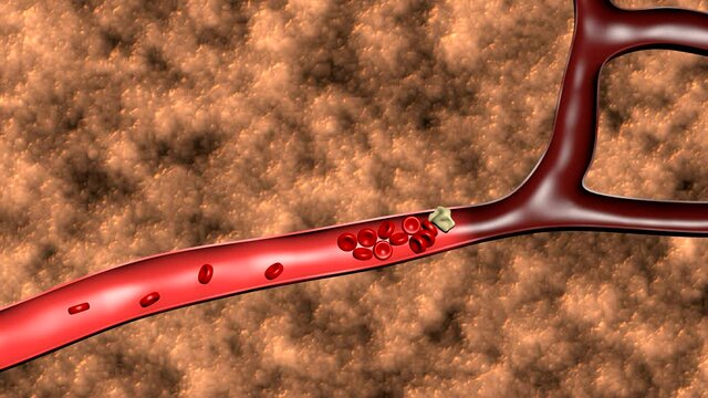 Animation of the formation of thrombosis 