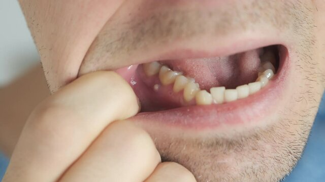 Dental abscess fistula on man's gum near the tooth, closeup view. A tooth in a man's mouth with a temporary filling seal. Caries dental concept. Dental treatment of the internal parts of the tooth.