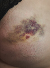 Fototapeta premium close up of skin with injury because of an accident