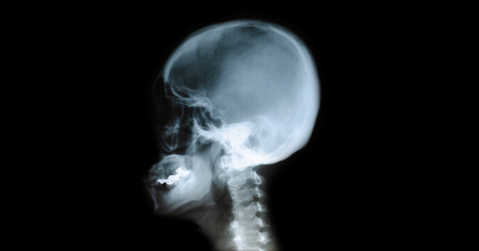 X-ray film of the head, child's skull.