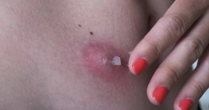 Rubbing medicinal anti-inflammatory ointment as treatment for boil caused by insect sting. Dermatology, furunculosis, furuncle, close up.