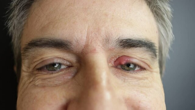Mature Caucasian male with green eyes showing a large stye on his left eye.