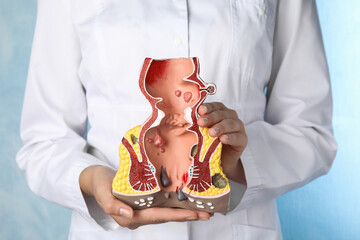 Doctor holding model of unhealthy lower rectum on light blue background, closeup. Hemorrhoid problem - obrazy, fototapety, plakaty