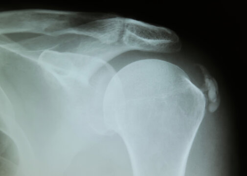 X-Ray image of calcified shoulder (Tendinosis calcarea)