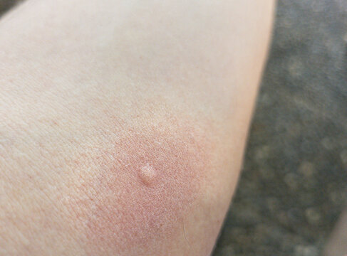 Close-up of skin with a mosquito bite and reddened skin