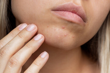 Cropped shot of a young woman's face with the problem of acne. Pimples on the chin. Allergies,...
