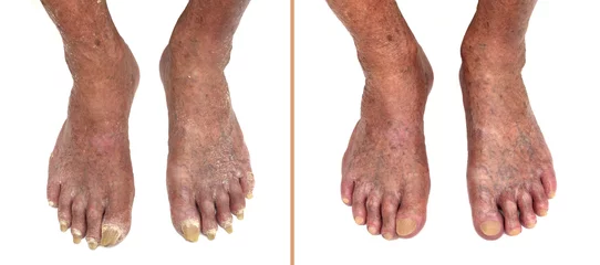 Selbstklebende Fototapeten Feet of a very old man with long and damaged nails and dry skin before and after pedicure treatment. Isolated on the white background.  © zdravinjo