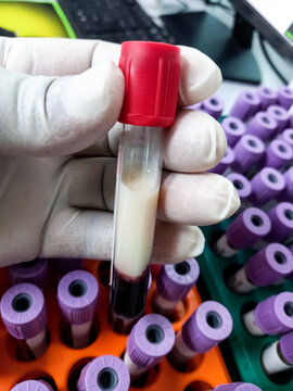 Scientist or Biochemist hold Lipemic blood sample. High Triglyceride contain blood sample.
