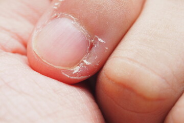 Closeup of deformed nails and skin peeling off from human nail biting behavior Medical and healthcare concept 